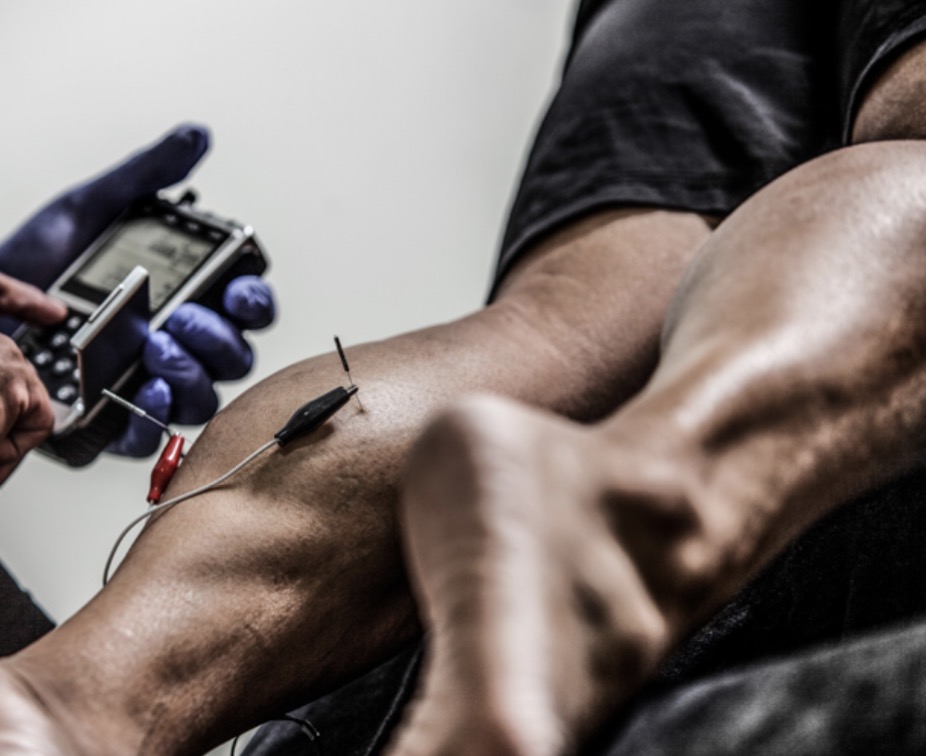 Dry Needling