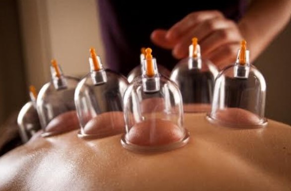 Hijama médicale